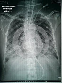 Chest X-Ray of suspected Corona virus patient high quality image showing changes in the lung due to Covid-19 virus with chest tube