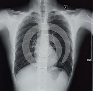 Chest X-rays