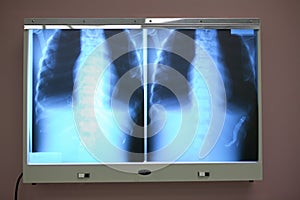 Chest and thorax x-ray on a viewing light box