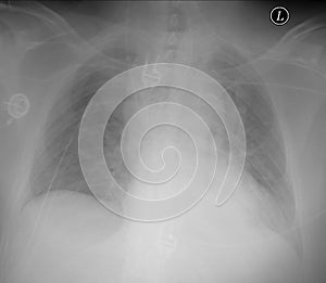 Chest X-Ray