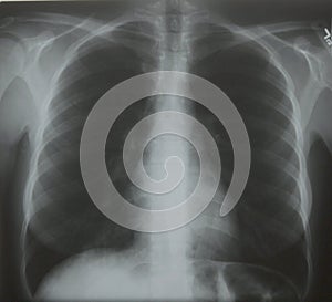 Chest X-ray
