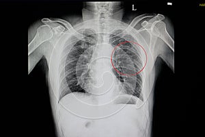 chest x-ray of a blunt chest wall injuried patient photo