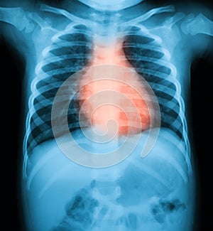 Chest X-ray imag of a young boy.