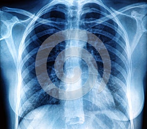 Chest X-ray image photo