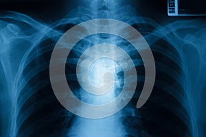 Chest x-ray