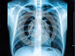 Chest X-ray Image