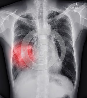 Chest X-ray or X-Ray Image Of Human Chest showing tuberculosis.