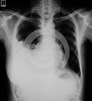 Chest X-ray image of Lung infection.