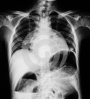 Chest X-ray image, PA upright view.