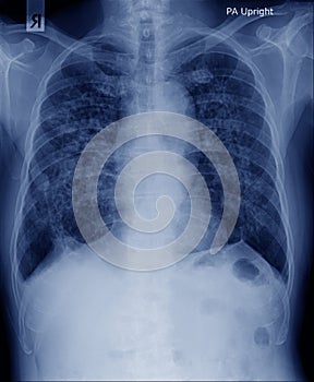 Chest x-ray image with secretion photo