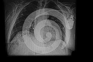 Chest X Ray image showing heart pacemaker.
