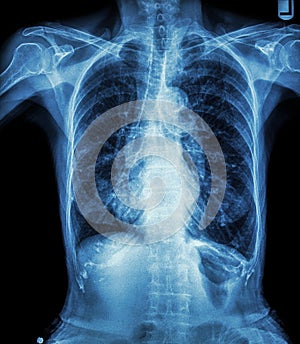 Chest X-ray of old patient ( calcification at rib , trachea , bronchus ) photo