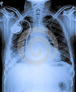 Chest X Ray with Pacemaker