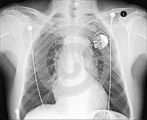 Chest X ray img
