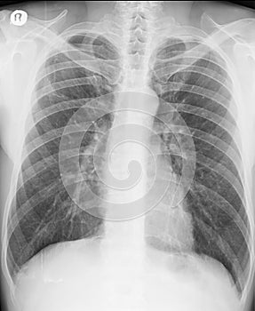Chest X-ray. Posteroanterior view. Two years after spontaneous pneumothorax. photo