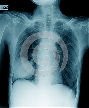 Chest x-ray lobectomy