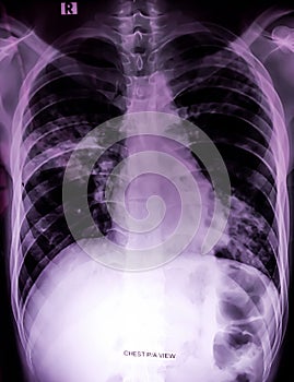 Chest x-ray showing patchy opacification.