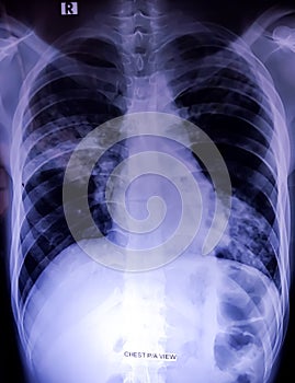 Chest x-ray showing patchy opacification.