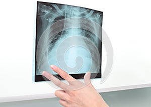 Chest X-ray to negatoscope.