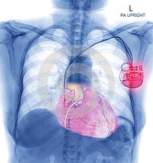 Chest X-ray or X-Ray Image Of Human Chest with pacemaker placement