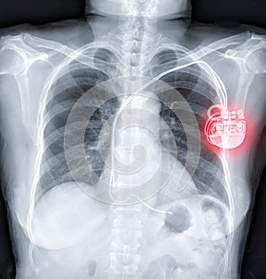Chest X-ray or X-Ray Image Of Human Chest with pacemaker placement photo