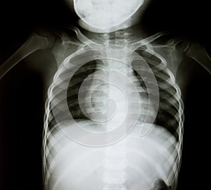 Chest x-ray of young boy
