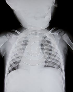 Chest x-ray of young boy.