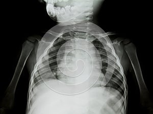 Chest x-ray