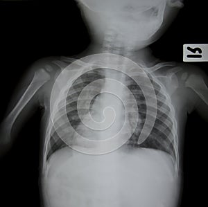 Chest x-ray