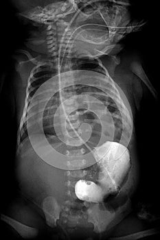 Chest x-ray of young boy.