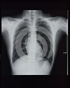 Chest X-rays