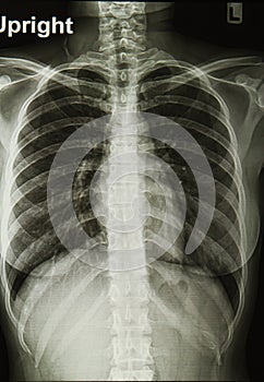 Chest X-rays image