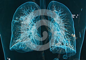 Chest X-rays lungs 3d image