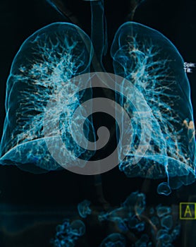 Chest X-rays lungs 3d image