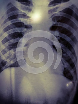 Chest x-rays show advanced pulmonary tuberculosis.