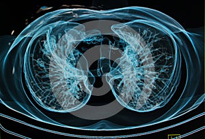 Chest X-rays under 3d image photo