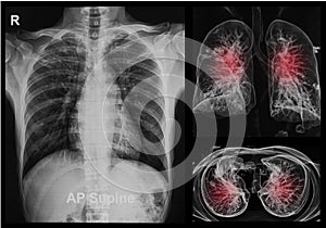 Chest X-rays under 3d image