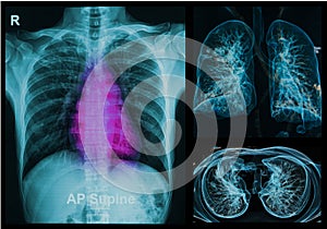 Chest X-rays under 3d image
