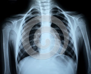 Chest xray img