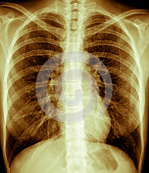 Chest Xray,Female