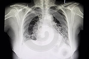 A chest xray film of patient with heart failure