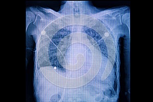 A chest xray film of a patient with cardiomegaly