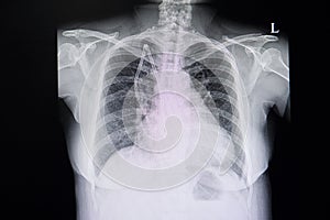 chest xray film of a patient with double lumen catheter