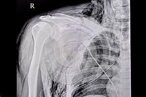 Chest xray film of a patient with fracture of left clavicle, ribs 2rd to 7th, fracture scapular, hemothorax, and subcutaneous