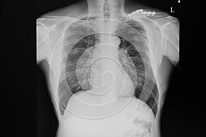 Chest xray film of a patient with fractured clavicle