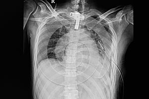 Pulmonary contusion and hemothorax with ICD photo