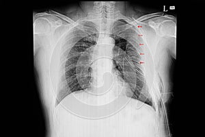 chest xray  film of a patient with multiple rib fractures