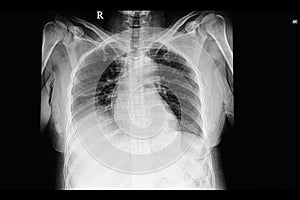A chest xray film of a patient with pleural effusion