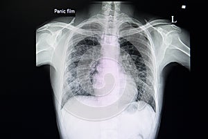 A chest xray film of a patient with  pneumonia