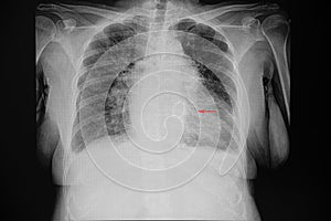 A chest xray of  a patient with cardiomegaly